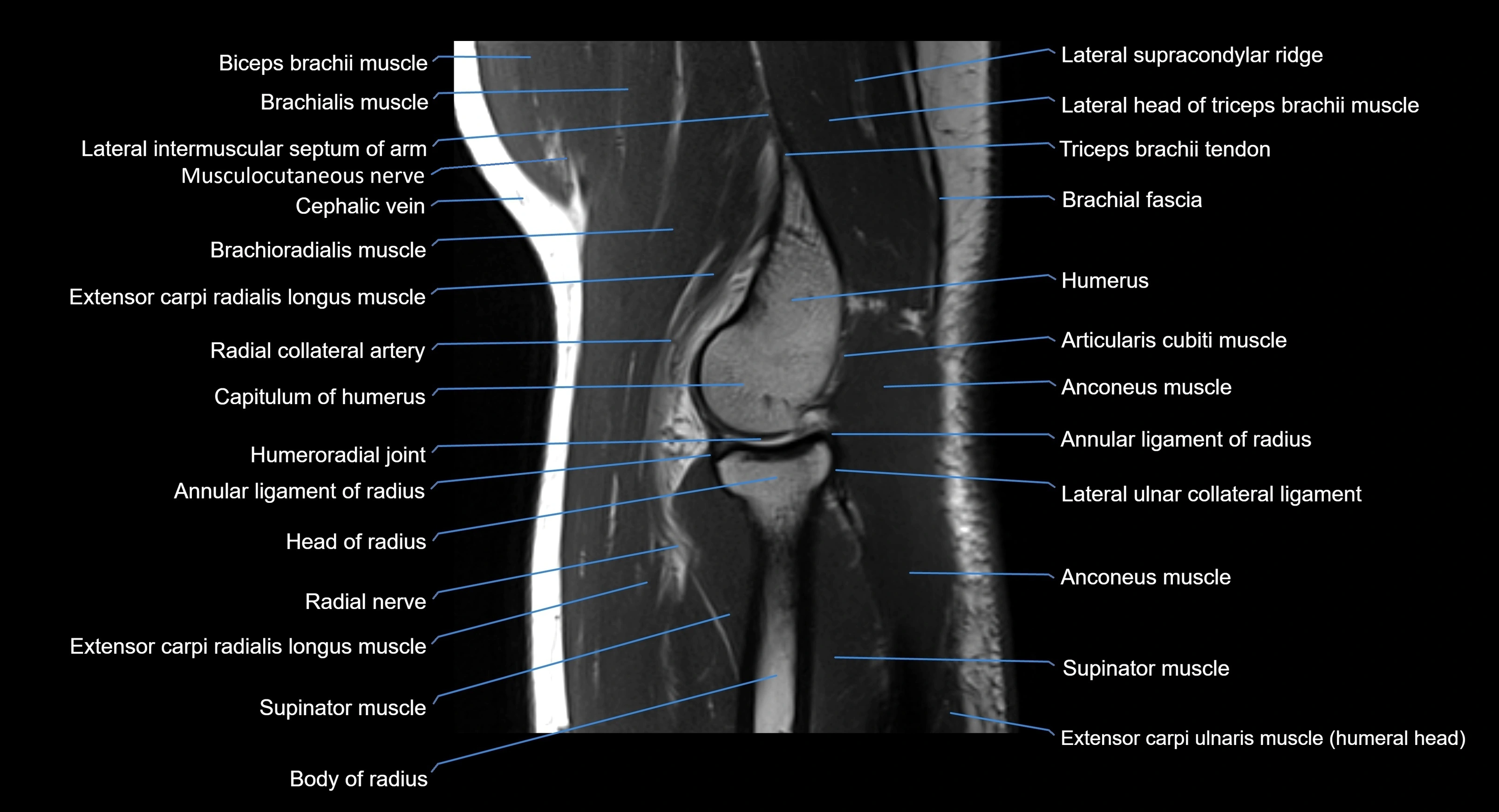 MRI elbow joint  sagittal cross sectional anatomy 3T  radiology  image-img-00001-00018.webp